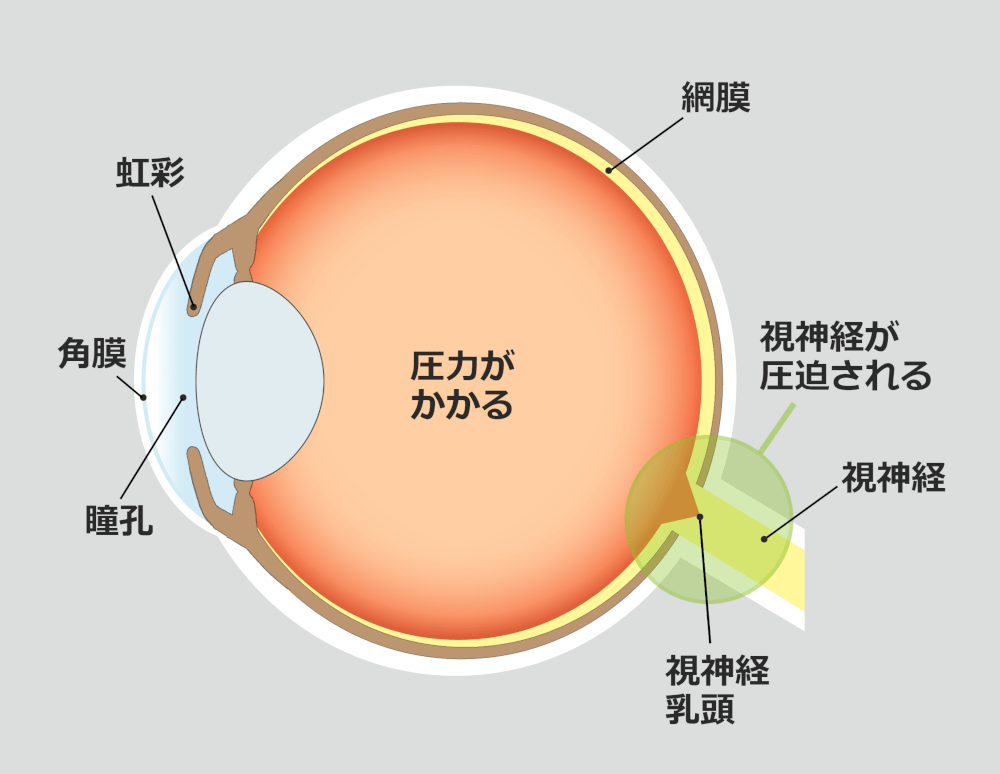 緑内障との違い