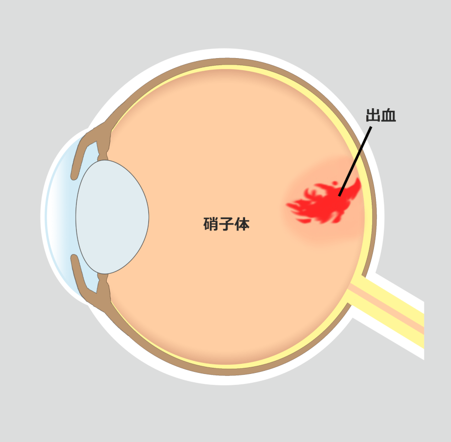 飛蚊症との違い