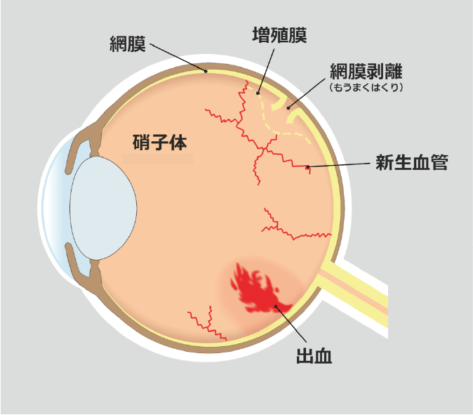 糖尿病網膜症との違い