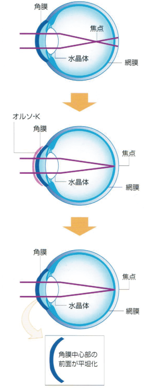 オルソケラトロジーとは何でしょう？